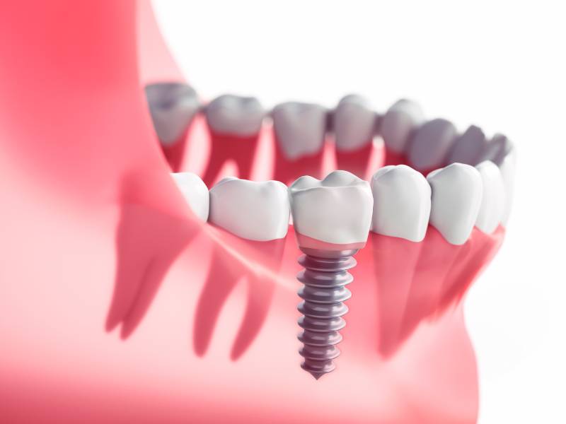 Example of a single tooth dental implant 